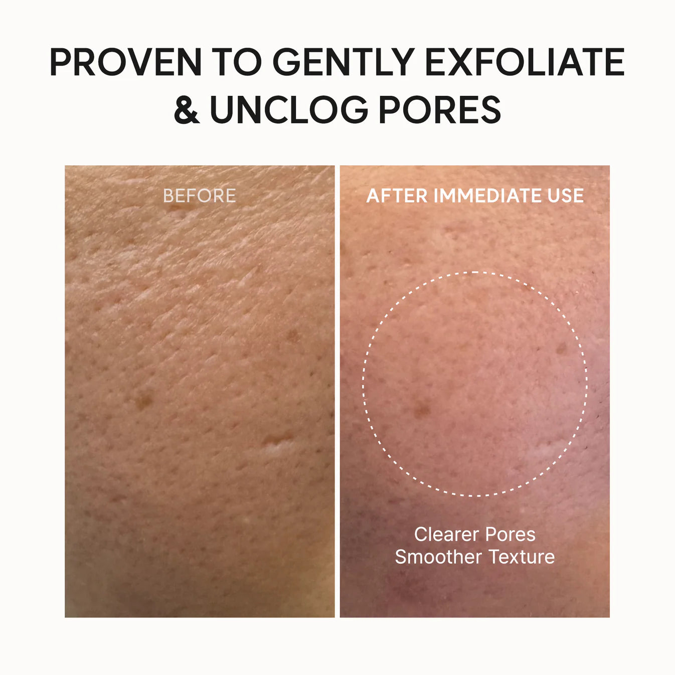 Before and after skin treatment showing clearer pores and smoother texture.