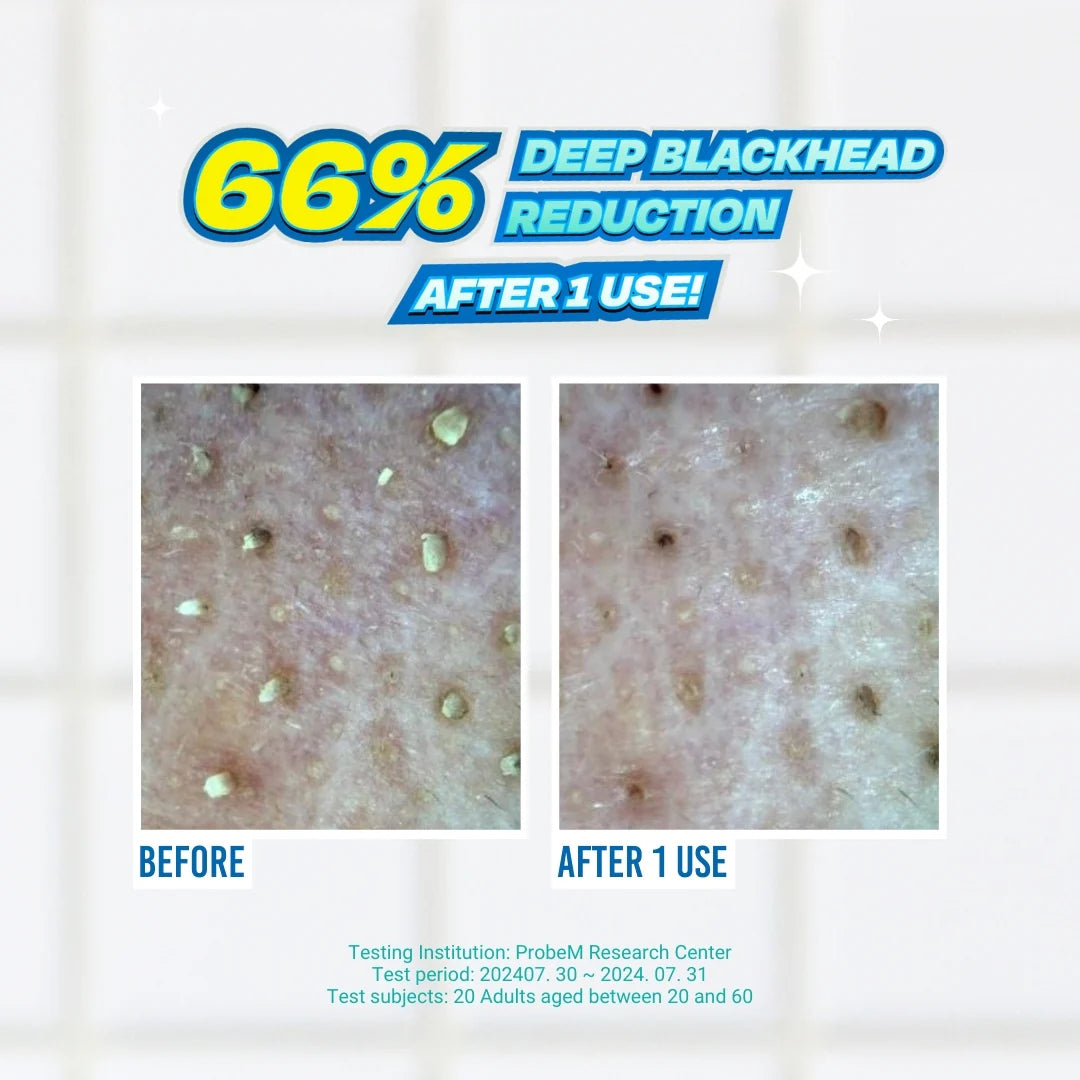 Before and after comparison of blackhead reduction with text indicating 66% reduction after one use.