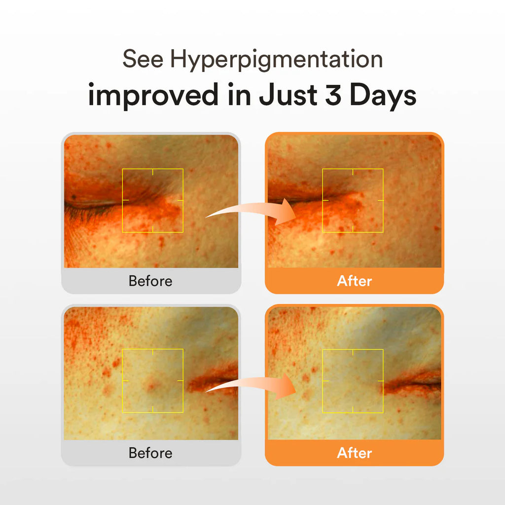 Before and after comparison of hyperpigmentation improvement on skin with text 'See Hyperpigmentation improved in Just 3 Days'.