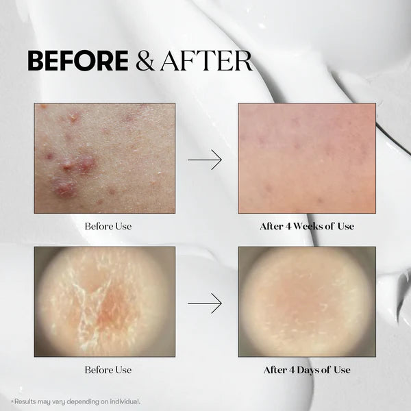 Before and after skin treatment results on a white background

Cutis Clinique Mild Reedle Shot 50 (5)