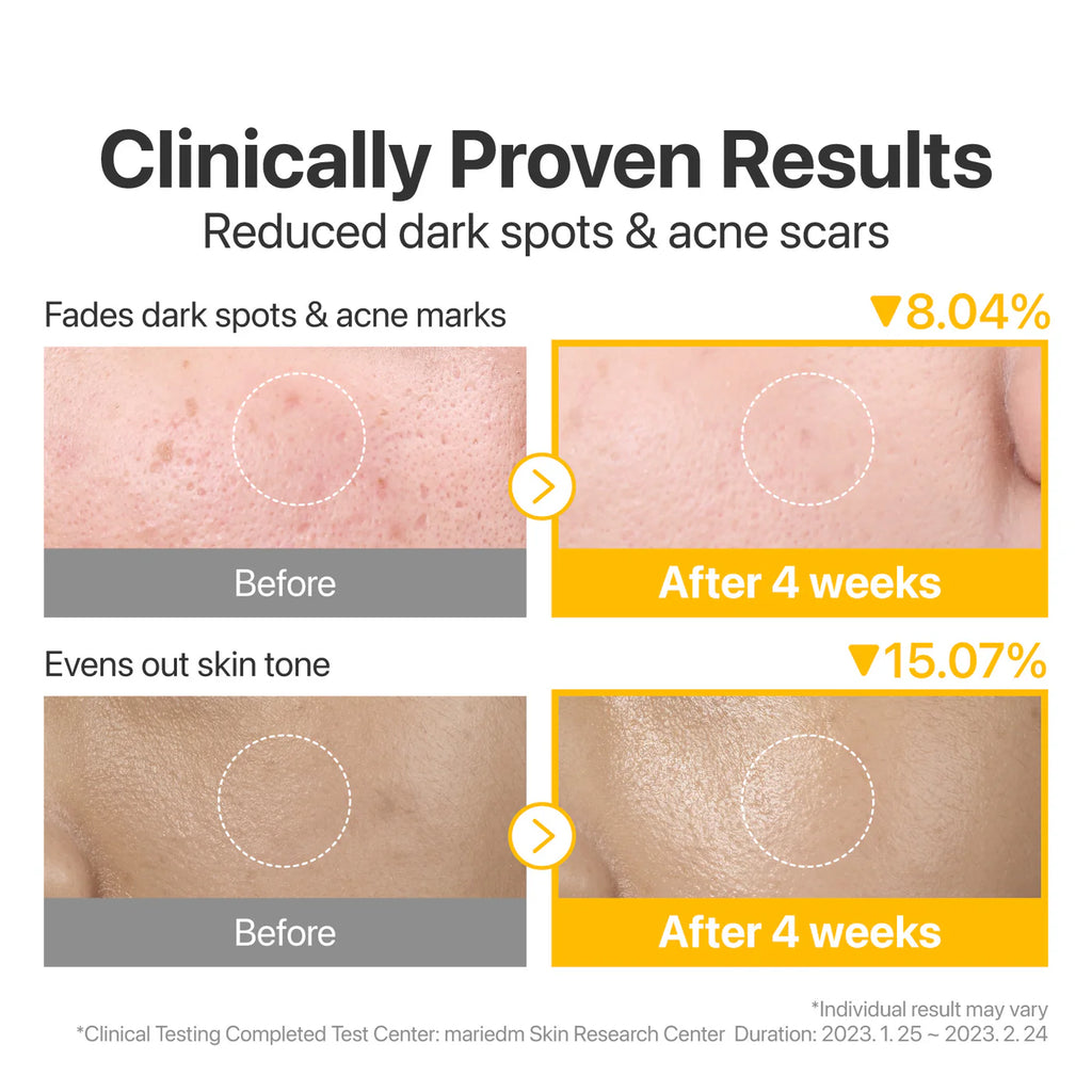 Before and after skin treatment results showing reduced dark spots and acne scars with clinical data.