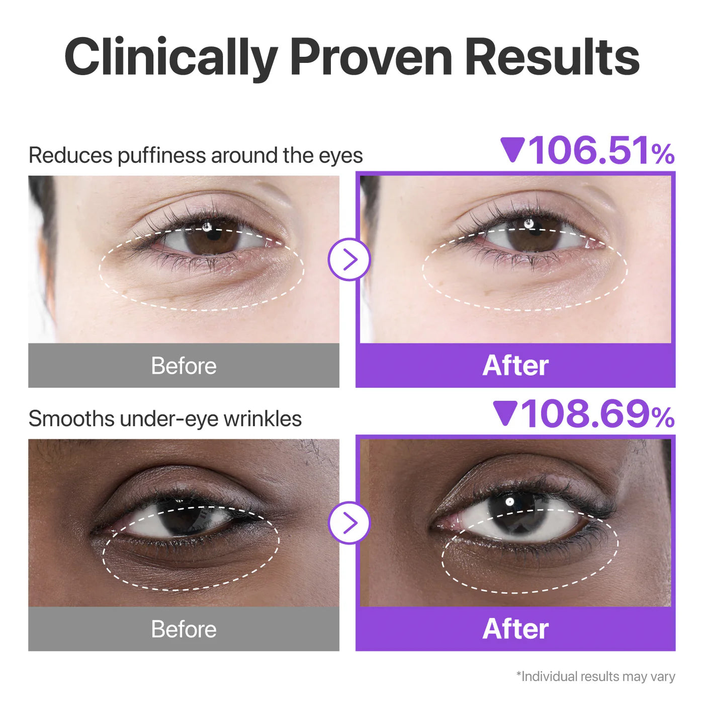 Before and after effects of eye cream on puffiness and wrinkles with clinical data.