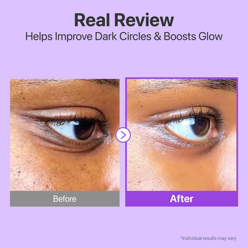 Before and after comparison of dark circles improvement with a purple background